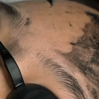 Clear Skin Laser Pen